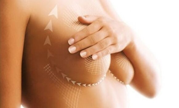 seam lift for breast augmentation
