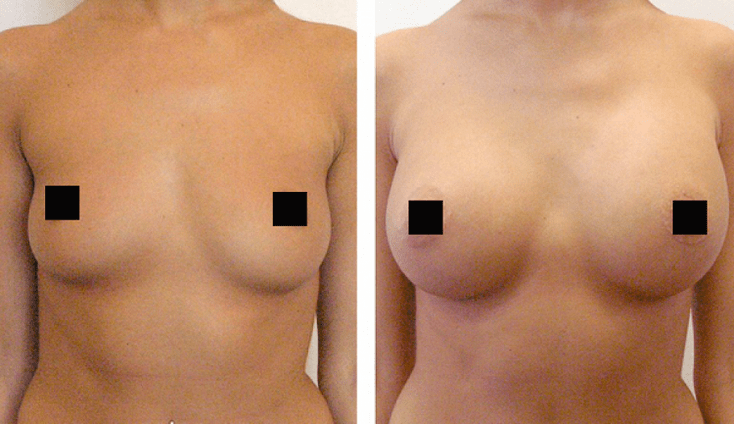 breast before and after hyaluronic acid augmentation
