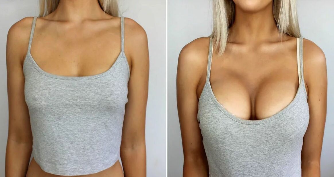 Breast enlargement 3 size