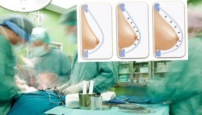 How is Lipilifting being performed