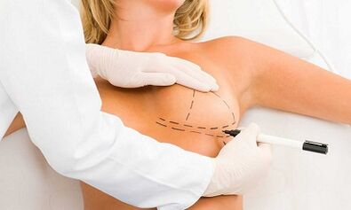 How to increase strokes of implants