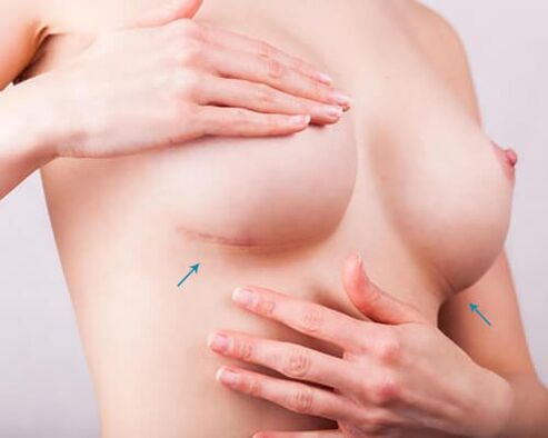 Breast enlargement with implants
