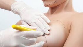 Breast Growth Surgery