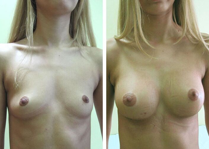 Breast before and after breast augmentation
