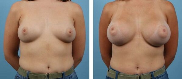 Photos before and after breast augmentation