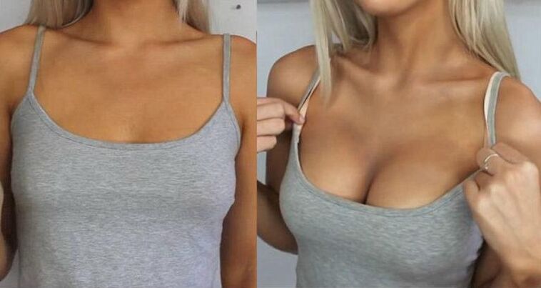 Before and after breast augmentation