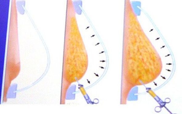 breast augmentation with fat