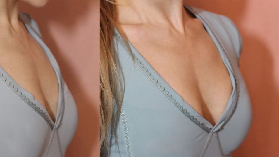 breast augmentation products before and after